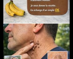 Les Acrochordons : Solutions Naturelles et Prévention pour Retrouver une Peau Saine et Esthétique